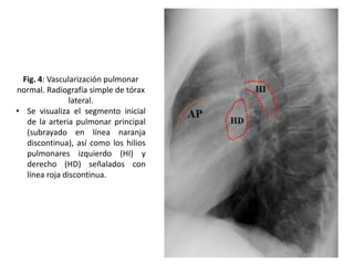 Fig. 4: Vascularización pulmonar
normal. Radiografía simple de tórax
lateral.
• Se visualiza el segmento inicial
de la arteria pulmonar principal
(subrayado en línea naranja
discontinua), así como los hilios
pulmonares izquierdo (HI) y
derecho (HD) señalados con
línea roja discontinua.

 