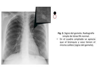 Fig. 5: Signo del gemelo. Radiografía
simple de tórax PA normal.
• En el cuadro ampliado se aprecia
que el bronquio y vaso tienen el
mismo calibre (signo del gemelo).

 