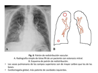 Fig. 6: Patrón de redistribución vascular.
A. Radiografía simple de tórax PA de un paciente con estenosis mitral.
B. Esquema de patrón de redistribución.
• Los vasos pulmonares de los campos superiores son de mayor calibre que los de las
bases.
• Cardiomegalia global, más patente de cavidades izquierdas.

 