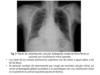 Fig. 7: Patrón de redistribución vascular. Radiografía simple de tórax PA de un
paciente con insuficiencia mitral operada.
• Los vasos de los campos pulmonares superiores son de mayor o igual calibre a los
de las bases.
• Se aprecian cambios de esternotomía por cirugía de recambio valvular mitral, así
como cardiomegalia global secundaria a la valvulopatía con una calcificación lineal
en la pared de la aurícula izquierda (punta de flecha).

 