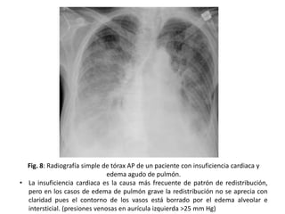Fig. 8: Radiografía simple de tórax AP de un paciente con insuficiencia cardiaca y
edema agudo de pulmón.
• La insuficiencia cardiaca es la causa más frecuente de patrón de redistribución,
pero en los casos de edema de pulmón grave la redistribución no se aprecia con
claridad pues el contorno de los vasos está borrado por el edema alveolar e
intersticial. (presiones venosas en aurícula izquierda >25 mm Hg)

 