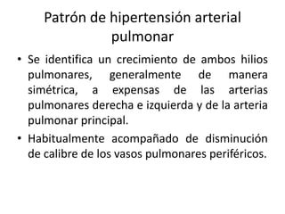 Patrón de hipertensión arterial
pulmonar
• Se identifica un crecimiento de ambos hilios
pulmonares, generalmente de manera
simétrica, a expensas de las arterias
pulmonares derecha e izquierda y de la arteria
pulmonar principal.
• Habitualmente acompañado de disminución
de calibre de los vasos pulmonares periféricos.

 