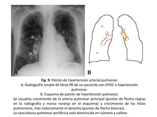 Fig. 9: Patrón de hipertensión arterial pulmonar.
A. Radiografía simple de tórax PA de un paciente con EPOC e hipertensión
pulmonar.
B. Esquema de patrón de hipertensión pulmonar.
Se visualiza crecimiento de la arteria pulmonar principal (puntas de flecha negras
en la radiografía y marca naranja en el esquema) y crecimiento de los hilios
pulmonares, más notoriamente el derecho (puntas de flecha blancas).
La vasculatura pulmonar periférica está disminuida en número y calibre.

 
