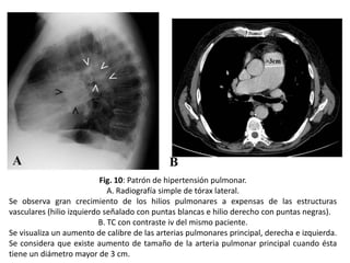 Fig. 10: Patrón de hipertensión pulmonar.
A. Radiografía simple de tórax lateral.
Se observa gran crecimiento de los hilios pulmonares a expensas de las estructuras
vasculares (hilio izquierdo señalado con puntas blancas e hilio derecho con puntas negras).
B. TC con contraste iv del mismo paciente.
Se visualiza un aumento de calibre de las arterias pulmonares principal, derecha e izquierda.
Se considera que existe aumento de tamaño de la arteria pulmonar principal cuando ésta
tiene un diámetro mayor de 3 cm.

 