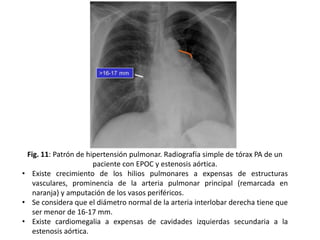 Fig. 11: Patrón de hipertensión pulmonar. Radiografía simple de tórax PA de un
paciente con EPOC y estenosis aórtica.
• Existe crecimiento de los hilios pulmonares a expensas de estructuras
vasculares, prominencia de la arteria pulmonar principal (remarcada en
naranja) y amputación de los vasos periféricos.
• Se considera que el diámetro normal de la arteria interlobar derecha tiene que
ser menor de 16-17 mm.
• Existe cardiomegalia a expensas de cavidades izquierdas secundaria a la
estenosis aórtica.

 