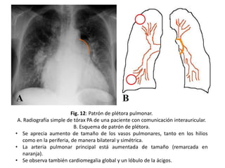 Fig. 12: Patrón de plétora pulmonar.
A. Radiografía simple de tórax PA de una paciente con comunicación interauricular.
B. Esquema de patrón de plétora.
• Se aprecia aumento de tamaño de los vasos pulmonares, tanto en los hilios
como en la periferia, de manera bilateral y simétrica.
• La arteria pulmonar principal está aumentada de tamaño (remarcada en
naranja).
• Se observa también cardiomegalia global y un lóbulo de la ácigos.

 