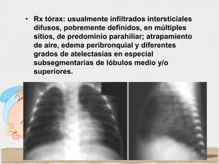 • Rx tórax: usualmente infiltrados intersticiales
difusos, pobremente definidos, en múltiples
sitios, de predominio parahiliar; atrapamiento
de aire, edema peribronquial y diferentes
grados de atelectasias en especial
subsegmentarias de lóbulos medio y/o
superiores.
 