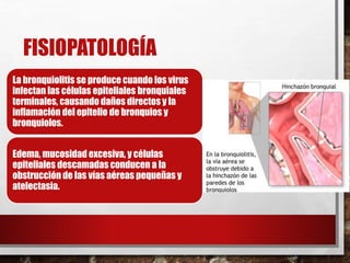 FISIOPATOLOGÍA
La bronquiolitis se produce cuando los virus
infectan las células epiteliales bronquiales
terminales, causando daños directos y la
inflamación del epitelio de bronquios y
bronquiolos.
Edema, mucosidad excesiva, y células
epiteliales descamadas conducen a la
obstrucción de las vías aéreas pequeñas y
atelectasia.
 