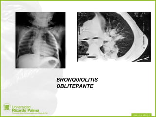 BRONQUIOLITIS OBLITERANTE 