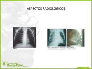ASPECTOS RADIOLÓGICOS 