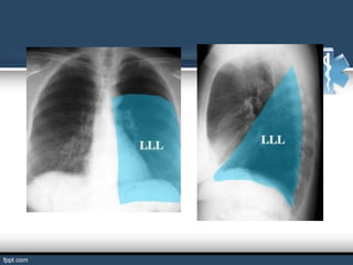 Lóbulo inferior izquierdo
 