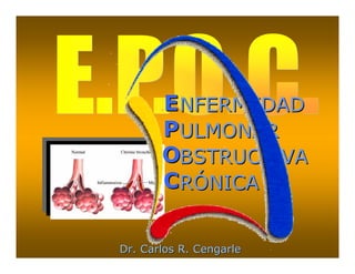 E NFERMEDAD
       PULMONAR
       OBSTRUCTIVA
       CRÓNICA


Dr. Carlos R. Cengarle