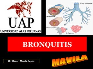 BRONQUITIS
Dr. Oscar Mavila Reyes
 