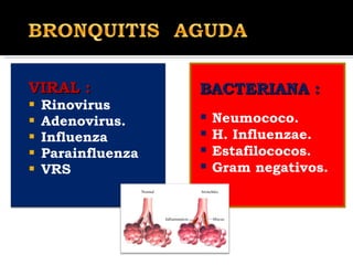 VIRAL : Rinovirus Adenovirus. Influenza Parainfluenza VRS BACTERIANA : Neumococo. H. Influenzae. Estafilococos. Gram negativos. 
