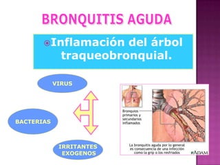 Inflamación

del árbol
traqueobronquial.

VIRUS

BACTERIAS

IRRITANTES
EXOGENOS

 