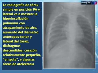 Bronquitis aguda | PPTX