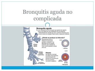 Bronquitis aguda no
complicada
 