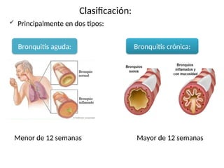 Clasificación:
 Principalmente en dos tipos:
Bronquitis aguda: Bronquitis crónica:
Menor de 12 semanas Mayor de 12 semanas
 