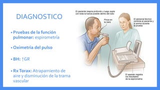 DIAGNOSTICO
• Pruebas de la función
pulmonar: espirometría
• Oximetrìa del pulso
• BH: ↑GR
• RxTorax: Atrapamiento de
aire y disminución de la trama
vascular
 