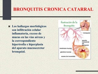 BRONQUITIS CRONICA CATARRAL
Los hallazgos morfológicos
son infiltración celular
inflamatoria, exceso de
mucus en las vías aéreas y
la correspondiente
hipertrofia e hiperplasia
del aparato mucosecretor
bronquial.
 