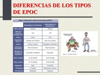 DIFERENCIAS DE LOS TIPOS
DE EPOC
 
