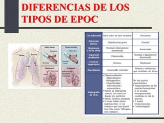 DIFERENCIAS DE LOS
TIPOS DE EPOC
 