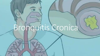 Bronquitis Cronica
 