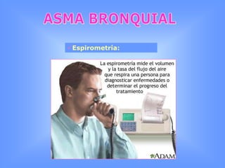 Asma mixtaASMA BRONQUIALPatogenia y fisiopatología:HIPER REACTIVIDAD BRONQUIAL Edema