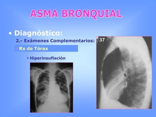 ASMA BRONQUIALPatogenia y fisiopatología:Interacciones:Mediadores deinflamaciónCélulasinflamatoriasCitoquinas