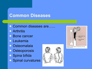 Common Diseases Common diseases are…... Arthritis Bone cancer Leukemia Osteomalaia Osteoporosis Spina bifida Spinal curvatures 
