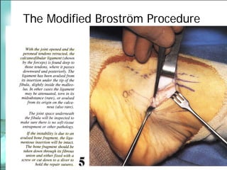 BroströM Procedure Presentation