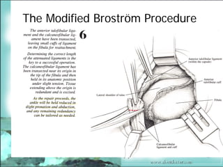 BroströM Procedure Presentation