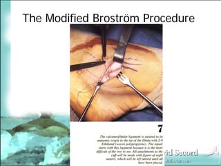 BroströM Procedure Presentation