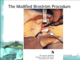 BroströM Procedure Presentation