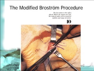 BroströM Procedure Presentation