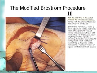 BroströM Procedure Presentation