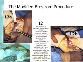 BroströM Procedure Presentation