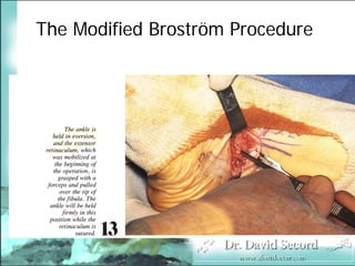 BroströM Procedure Presentation