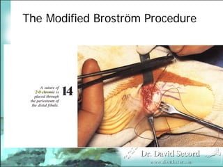 BroströM Procedure Presentation