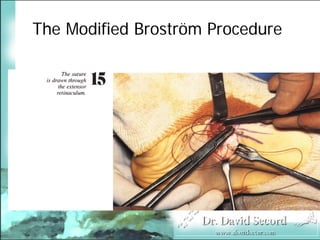 BroströM Procedure Presentation