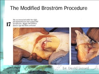 BroströM Procedure Presentation
