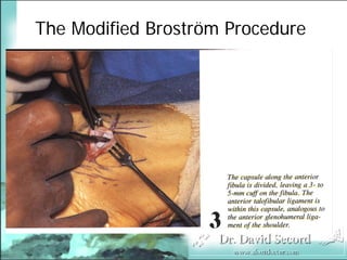 BroströM Procedure Presentation