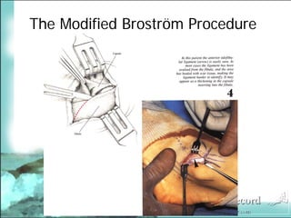 BroströM Procedure Presentation