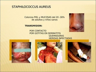 Brote Hospitalario de Infecciones Multirresistentes