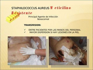 Brote Hospitalario de Infecciones Multirresistentes