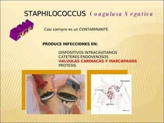 Brote Hospitalario de Infecciones Multirresistentes