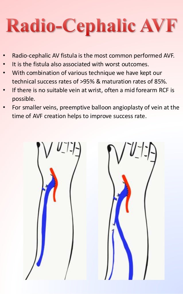 Arteriovenous fistula