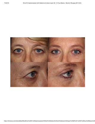 7/3/2018 Brow lift, blepharoplasty both bilateral and ptosis repair left - Dr Guy Massry - Beverly Hills.jpeg (641×423)
https://drmassry.com/sites/default/files/Brow%20lift,%20blepharoplasty%20both%20bilateral%20and%20ptosis%20repair%20left%20-%20Dr%20Guy%20Massry%20
 