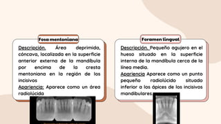 Fosa mentoniana Foramen lingual
Descripción. Área deprimida,
cóncava, localizada en la superficie
anterior externa de la mandíbula
por encima de la cresta
mentoniana en la región de los
incisivos
Apariencia: Aparece como un área
radiolúcida
Descripción. Pequeño agujero en el
hueso situado en la superficie
interna de la mandíbula cerca de la
línea media.
Apariencia Aparece como un punto
pequeño radiolúcido situado
inferior a los ápices de los incisivos
mandibulares.
 