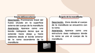 Cresta oblicua externa Ángulo de la mandíbula
Descripción. Prominencia lineal del
hueso situado en la superficie
externa del cuerpo de la mandíbula
Apariencia: Aparece como una
banda radiopaca densa que se
extiende hacia abajo y hacia
adelante desde el borde anterior
de la rama ascendente de la
mandíbula
Descripción. Zona donde el cuerpo
de la mandíbula se encuentra con
la rama.
Apariencia. Aparece como una
estructura ósea radiopaca donde
la rama se une al cuerpo de la
mandíbula.
 